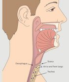 laryngectomy thumbnail